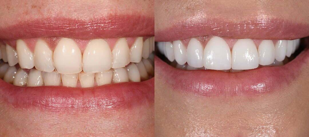 WSD Patient Tamar Before and After