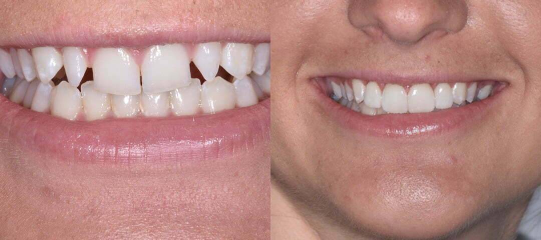 WSD Patient Ebony Before and After