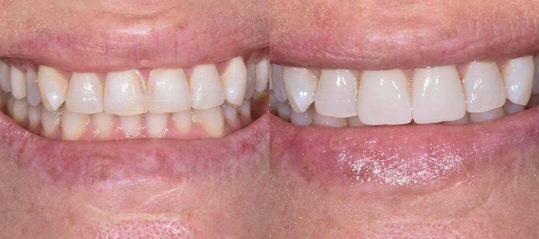WSD Patient Melina Before and After