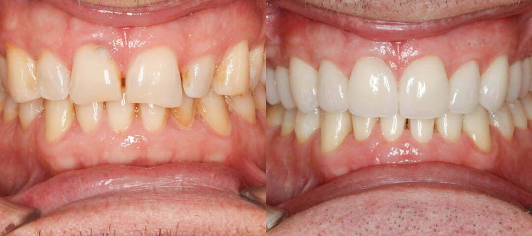 WSD Patient John Before and After