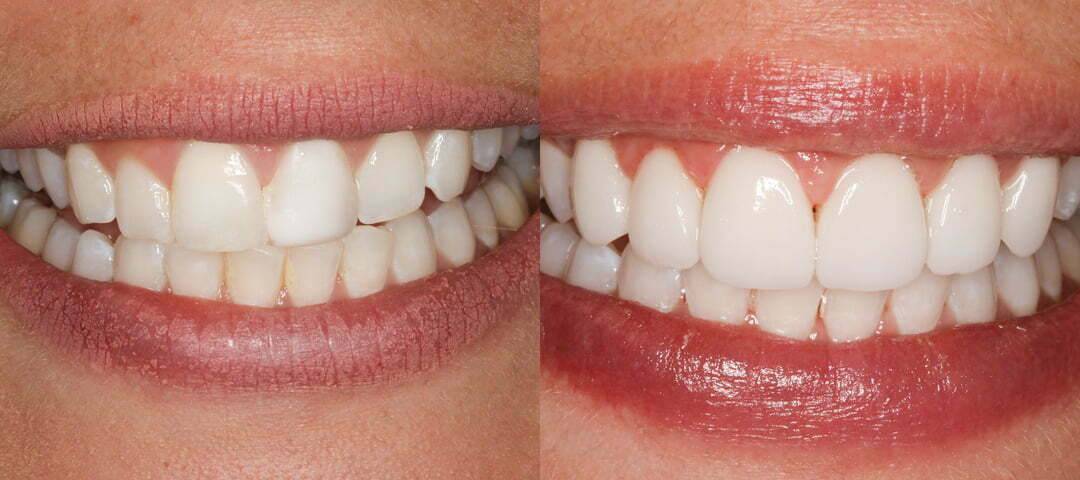 WSD Patient Zoe Before and After