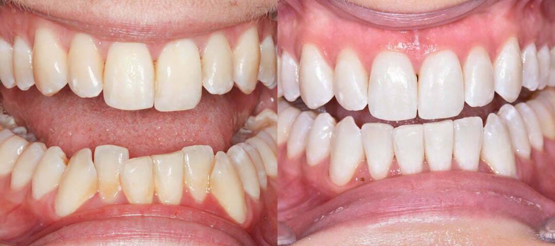 WSD Patient Emma Before and After