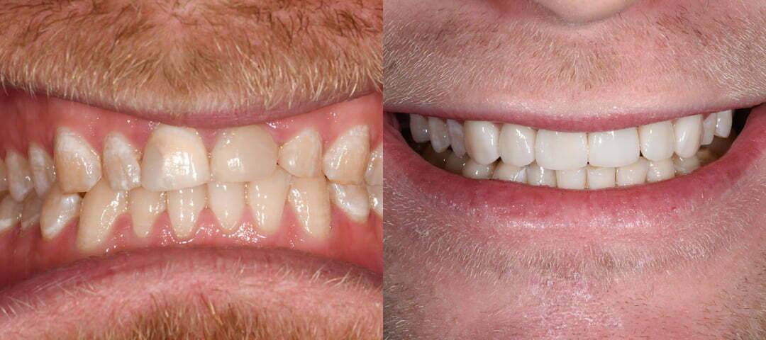 WSD Patient Jesse Before and After