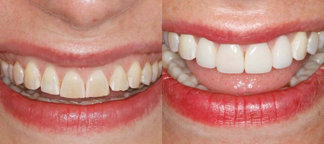 WSD Patient Amy Before and After