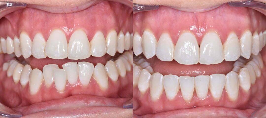WSD Patient Kelly Before and After