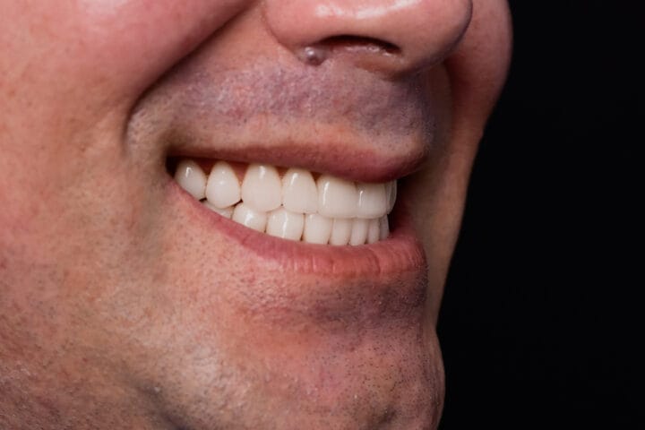 Crowns vs Veneers What’s the Difference
