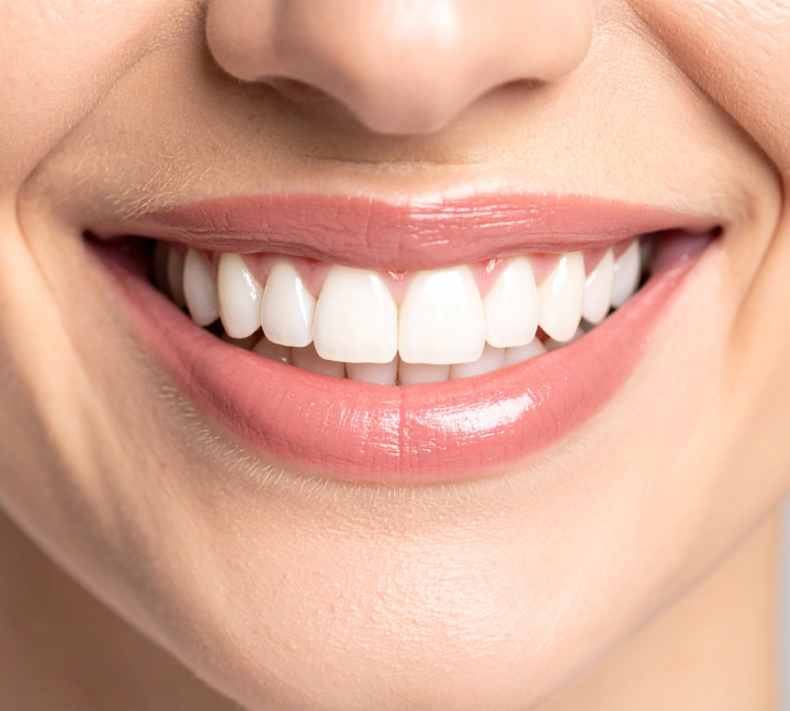 Veneers